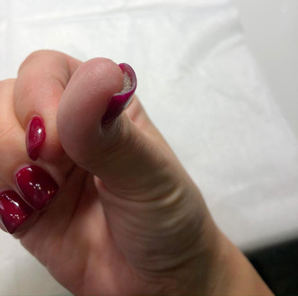 «Забила бы тревогу раньше, не пришлось бы удалять ногти»: как москвичка столкнулась с серьезными заболеваниями после некачественного маникюра